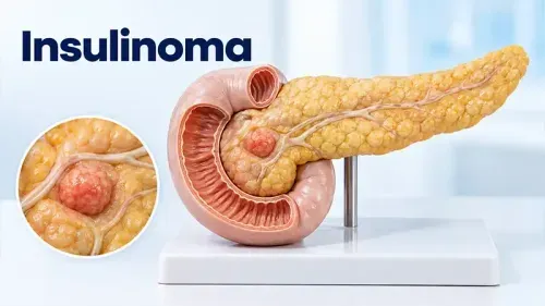 Insulinoma